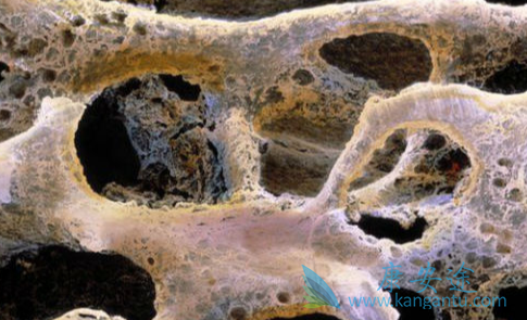 乳腺癌晚期;乳腺癌骨转移 乳腺癌晚期;乳腺癌骨转移