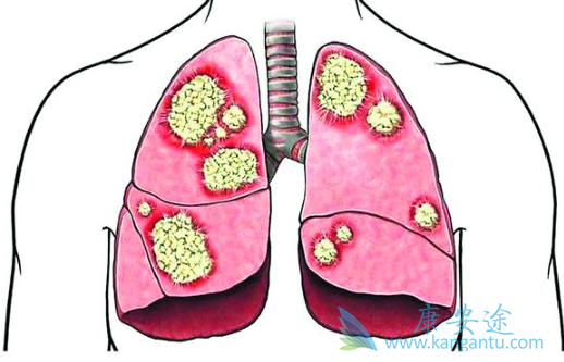 肺癌基因靶点 肺癌基因靶点