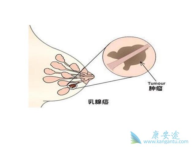 晚期乳腺癌 晚期乳腺癌