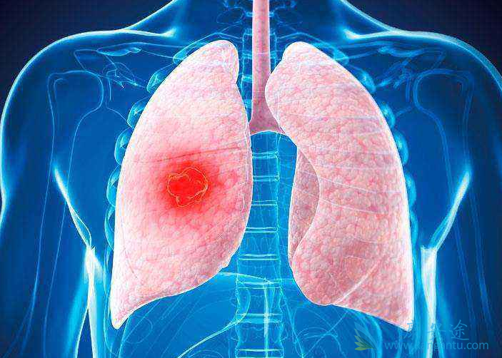 肺癌的早期症状;肿瘤转移 肺癌的早期症状;肿瘤转移