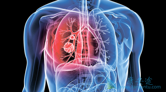 肺癌晚期症状;癌症 肺癌晚期症状;癌症