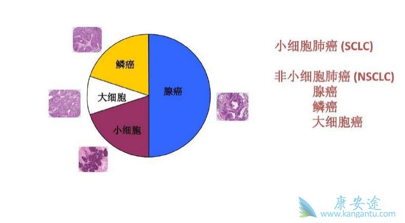 非小细胞肺癌 非小细胞肺癌