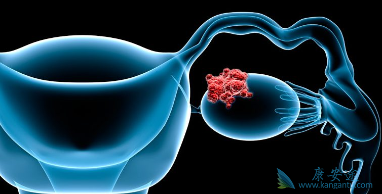 卵巢癌;卵巢癌的治疗 卵巢癌;卵巢癌的治疗