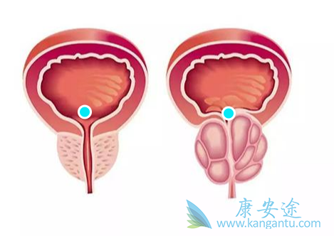 前列腺癌;阿比特龙 前列腺癌;阿比特龙