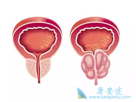 前列腺癌;治疗前列腺癌 前列腺癌;治疗前列腺癌