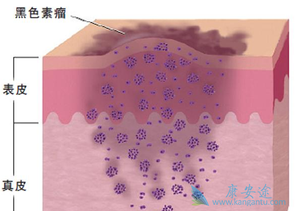 黑色素瘤;黑色素瘤治疗 黑色素瘤;黑色素瘤治疗