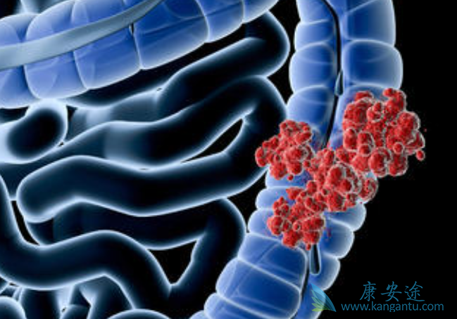 结直肠癌 结直肠癌