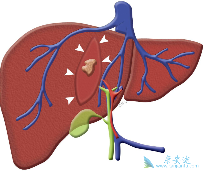 抗病毒治疗;肝癌 抗病毒治疗;肝癌