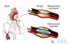 ʹ��������֧��֮����ܻ�������๦�����˵�֢״