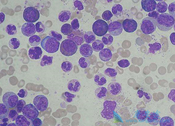 慢粒白血病 慢粒白血病