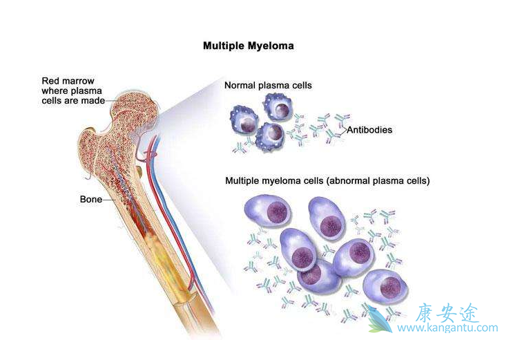 多发性骨髓瘤 多发性骨髓瘤