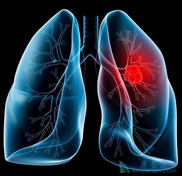 肺癌的预防 肺癌的预防