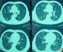 ת�Ʒ�ת����ָ��ʲô��˼�����Էΰ�֢״����Щ֢״��