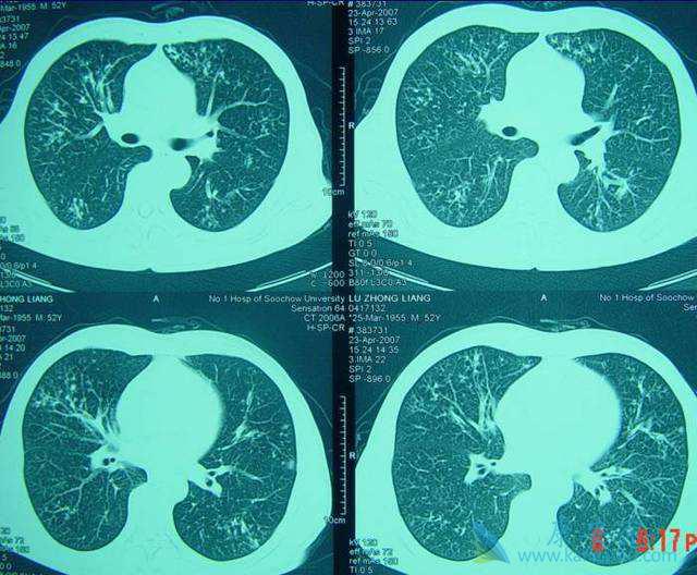 转移肺转癌 转移肺转癌