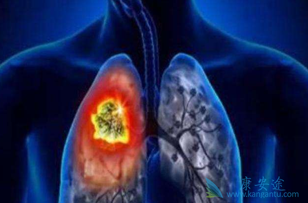 小细胞肺癌 小细胞肺癌