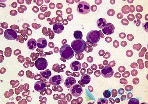 慢性白血病 慢性白血病