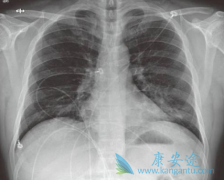 �����Τ(remdesivir)����Ч�Ͱ�ȫ���д���֤