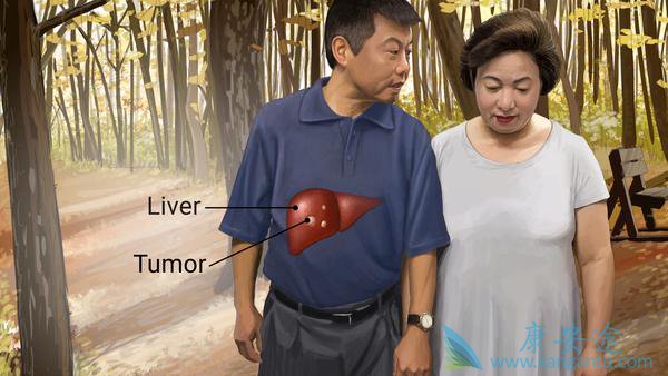 晚期肝癌治疗方法